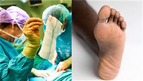 截肢　（示意圖/翻攝pixabay、 Wikimedia Commons）