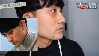 見寶貝兒子整型　爸媽嚇傻：為何毀容