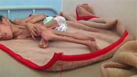  7歲男孩費德嚴重營養不良，體重只有7公斤。（圖／翻攝自Al-Sabeen醫院推特）