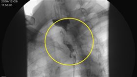 南投醫院提供食道癌案例