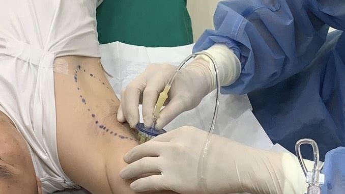 腋下狐臭難擋？醫籲止汗劑勿亂用