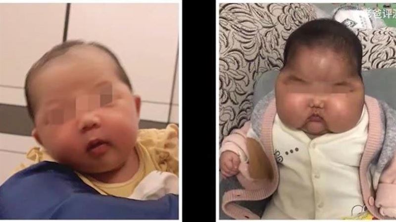 5個月嬰成大頭娃娃　疑為這產品惹禍