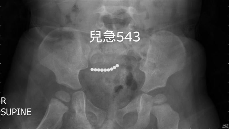 3歲童腹部見9個小白點　醫：破裂了