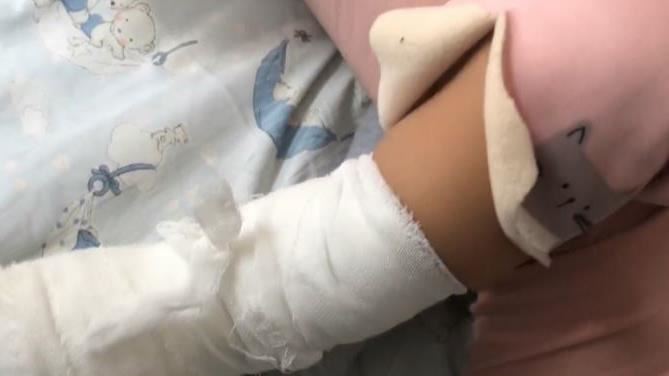 暖暖包爆炸！1歲兒燙傷送醫