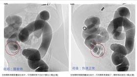 四個月大的小BABY，哭鬧斷斷續續，一開始以為撒嬌，後來無法安撫，甚至出現不喜歡喝奶的異常表現，警覺性立刻送到中國醫藥大學新竹附設醫院急診室，急診室主任游俊豪以超音波確認腸套疊。