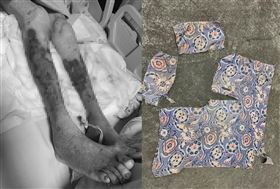 92歲吳姓阿嬤腳被野狗咬傷。（圖／翻攝自林妙香臉書）