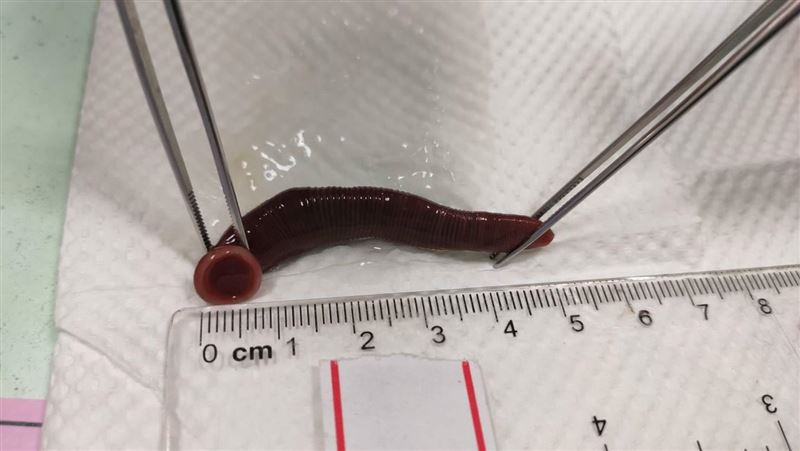 常喝山泉水　男在鼻內養大5公分水蛭