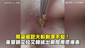 耳朵藏巨大粉刺渾不知！　美容師又拉又轉拔出瞬間療癒爆表