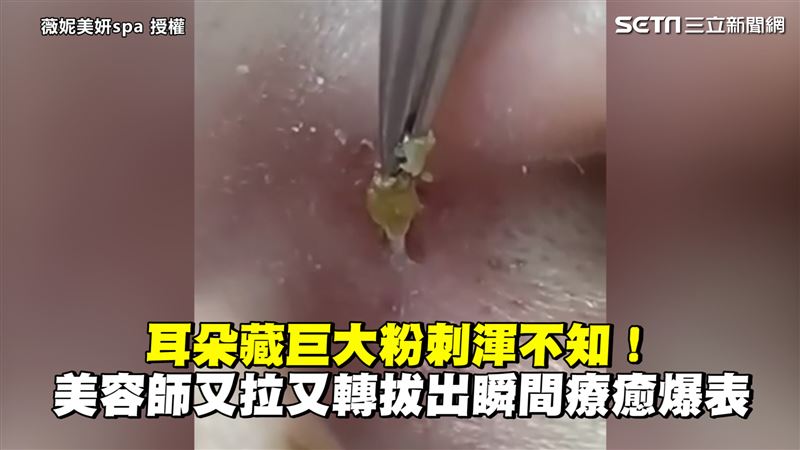 耳藏巨粉刺渾不知　她拔出瞬間超療癒