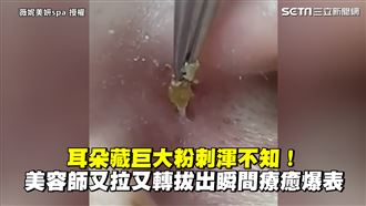 耳藏巨粉刺渾不知　她拔出瞬間超療癒
