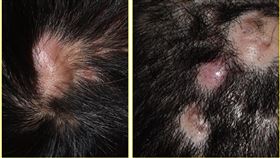 圖(一)：年輕男性於頭頂單一隆起病灶，伴隨落髮之現象；圖(二)：年輕男性於頭頂及枕區數個隆起病灶，亦有落髮之情形。