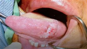 安南醫院,耳鼻喉科,劉金瑞,口腔癌,檳榔,口腔黏膜