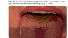 新冠舌頭（圖／翻攝自Tim Spectorw推特）