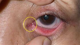 沒事也「哭」恐是鼻淚管阻塞　延誤恐釀蜂窩性組織炎(台北慈濟醫院提供)