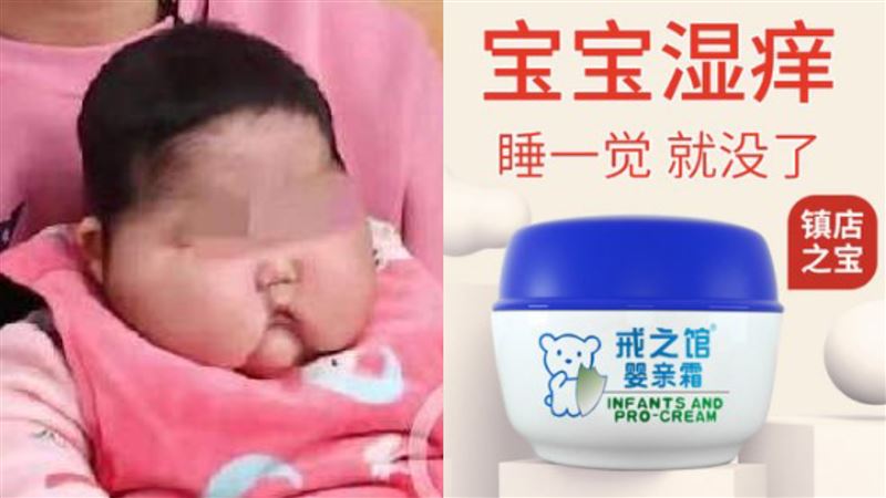 中國黑心連環爆！嬰慘變「大臉娃娃」