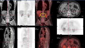 背痛莫輕忽！婦彎腰取物「啵」～突劇痛　竟罹多發性骨髓瘤（圖／亞大醫院提供）