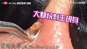 ▲超大粉刺王現身。（圖／Jin Yan 靜妍美學YouTube授權）