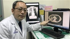 胸部電腦斷層掃描中，發現右上肺有肋膜積水的情形（圖／烏日林新醫院提供）
