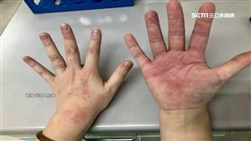 死守前線! 醫護雙手破皮起疹 護理長:沒人喊苦