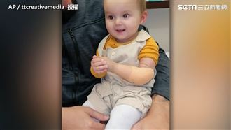 女嬰首裝義肢　露燦笑揮舞小手超級萌