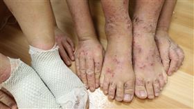 兄妹倆因罹患嚴重異位性皮膚炎，全身掻癢抓到體無完膚。（圖／台中慈濟醫院提供）