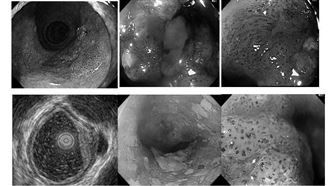 食道癌8招無聲殺人 醫警告7人危險
