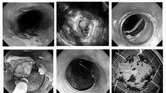 別一吃完就躺下！小心胃食道逆流