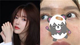  25歲中國女星高溜/整型/鼻子壞死/醫美/毀容。高溜微博