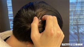 頭皮(資料照)