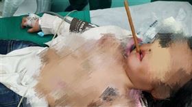 邊吃邊玩！3歲童跌倒「禍從口入」　筷子插入顱內10公分（圖／翻攝自中南大學湘雅醫院微博）