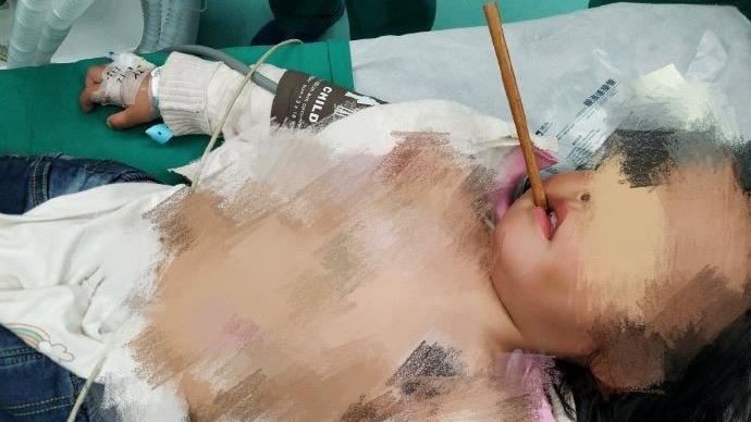 3歲妹邊吃邊玩　筷子插入顱內十公分