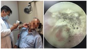 誤拿發黴棉花棒掏耳　男子菇寮工作耳朵也「長菇」（南投醫院提供）