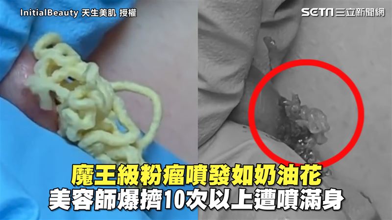 粉瘤噴發如奶油花　她爆擠遭噴滿身