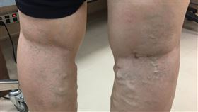 大千綜合醫院,心臟外科,楊智鈞,靜脈曲張,黑紫色的血管絲
圖／院方提供