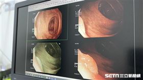 大腸鏡（讀者提供）