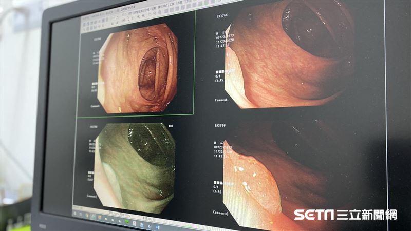 糞便檢查有潛血　「這種腹瀉」不單純