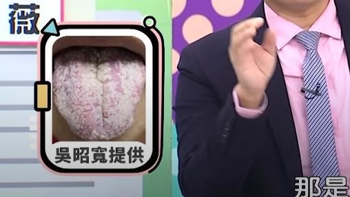 女歌手沙啞口乾　舌頭長滿糖霜狀黴菌