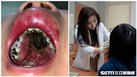 50歲婦冒膿狀鼻涕、口腔潰瘍　確診「淋巴癌」1個月不治（長庚醫院提供）