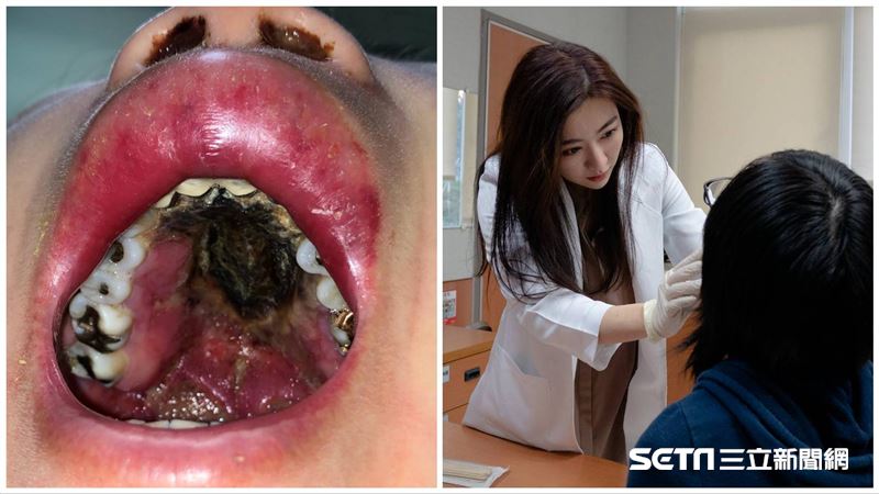 張嘴赫見焦黑狀壞死　就醫1個月往生