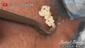 ▲最後擠出一大坨白色奶油花粉刺。（圖／InitialBeauty 天生美肌 授權）