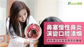 
名家專用／NOW健康／50歲女性鼻塞與慢性鼻炎連續3年，同時有化膿樣鼻涕，曾經接受治療效果不佳，沒想到口腔內硬顎及軟顎間出現無痛性潰瘍，並伴隨上嘴唇腫大求診皮膚科，診斷發現惡性腫瘤。(勿用)