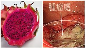 吃火龍果解紅便不以為意　竟是直腸癌(北市聯醫提供)