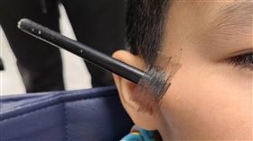 80公分弓箭穿男童臉　差一點爆眼球（南投醫院提供）