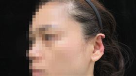彰化30歲林小姐被疑似患有精神疾病的鄰居咬掉三分之一的左耳（圖／翻攝自彰化醫院粉專）
