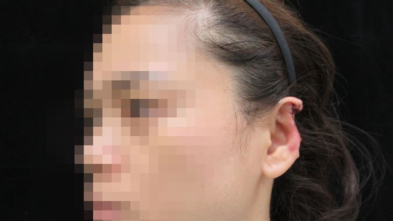 耳朵被鄰咬掉　30歲女三個月造斷耳