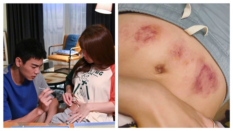 郭書瑤曝光插針瘀青肚　惹網心疼哭爆