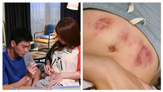 郭書瑤曝光插針瘀青肚　惹網心疼哭爆