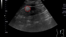 李女士到腎臟科進一步經超音波檢查，經診斷為「腎臟血管肌肉脂肪瘤」（圖／亞大醫院提供）