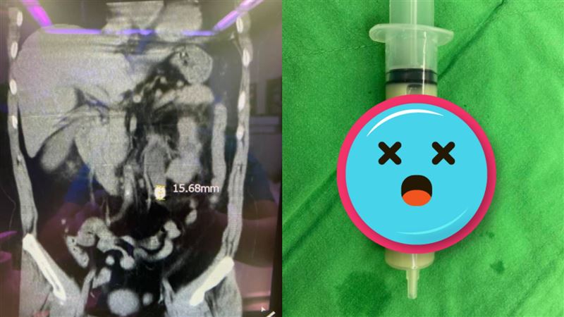 婦腰痠數週！醫抽出大管「抹茶」嚇壞