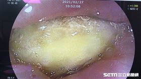 挺台灣鳳梨！男「整塊吃」噎到了　緊急內視鏡夾出（南投醫院提供）